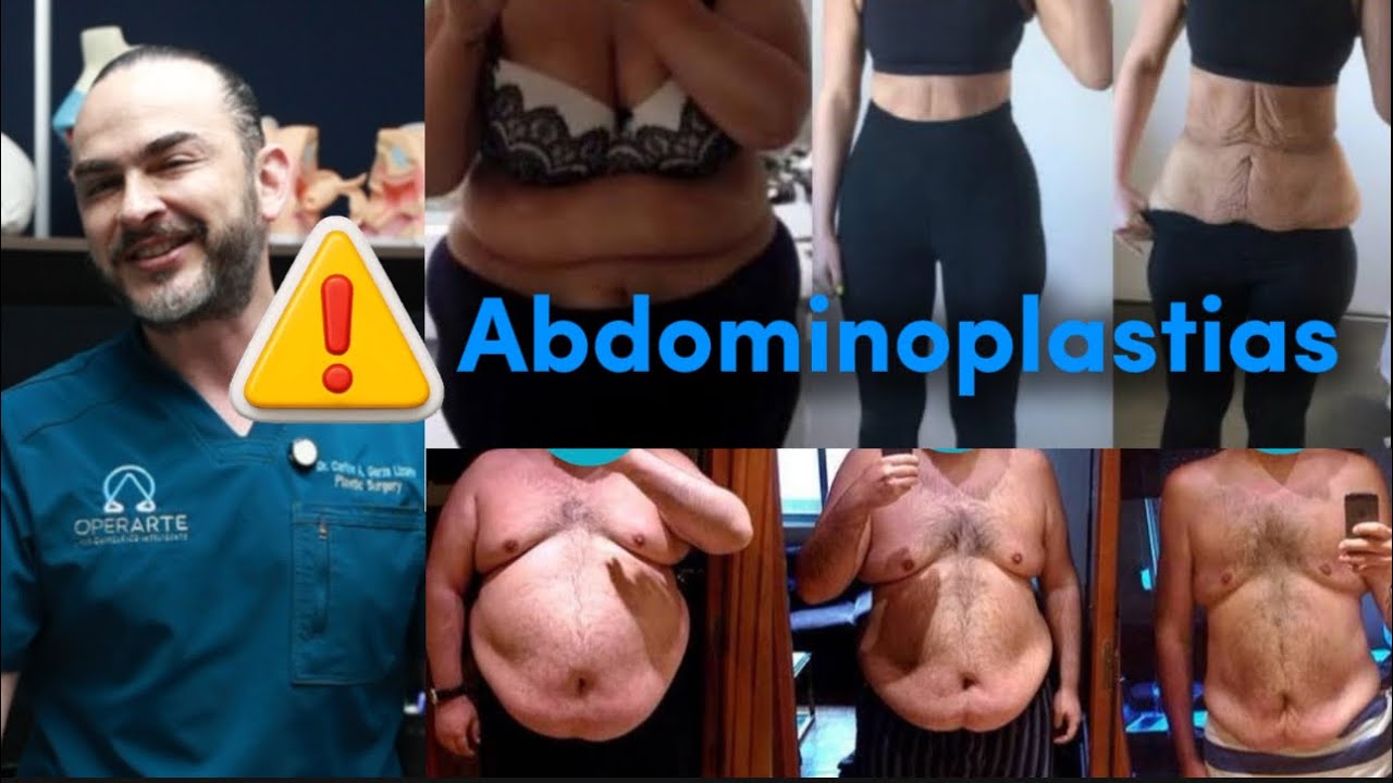 ABDOMINOPLASTIA | Todo lo que necesitas saber 