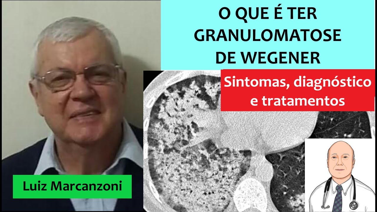 As experiências de quem tem granulomatose com poliangeite (antes chamada Wegener)