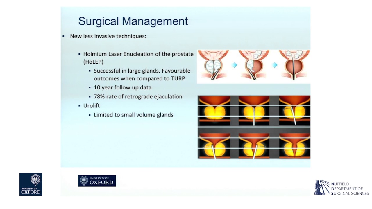 Oxford University surgical lectures: prostate artery embolisation in the management of BPH