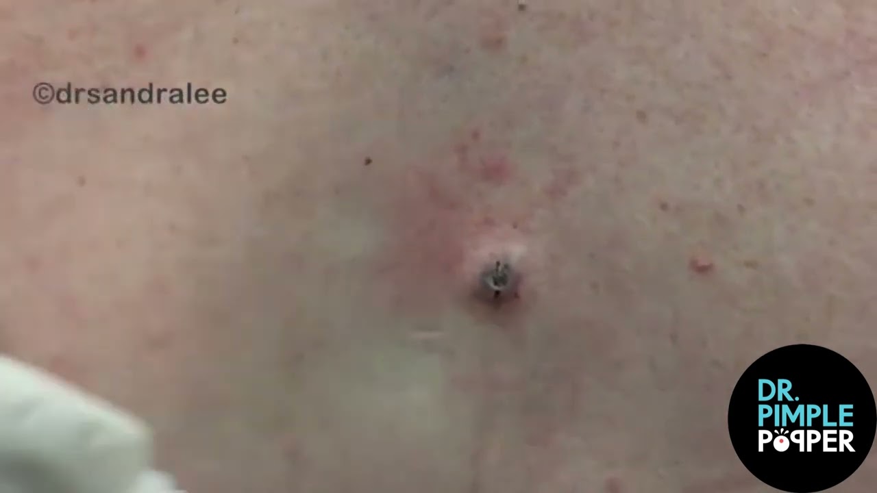 8 МИНУТ УДОВЛЕТВОРИТЕЛЬНЫХ ЛЕПЕШЕК с доктором Сандрой Ли / Dr Pimple Popper