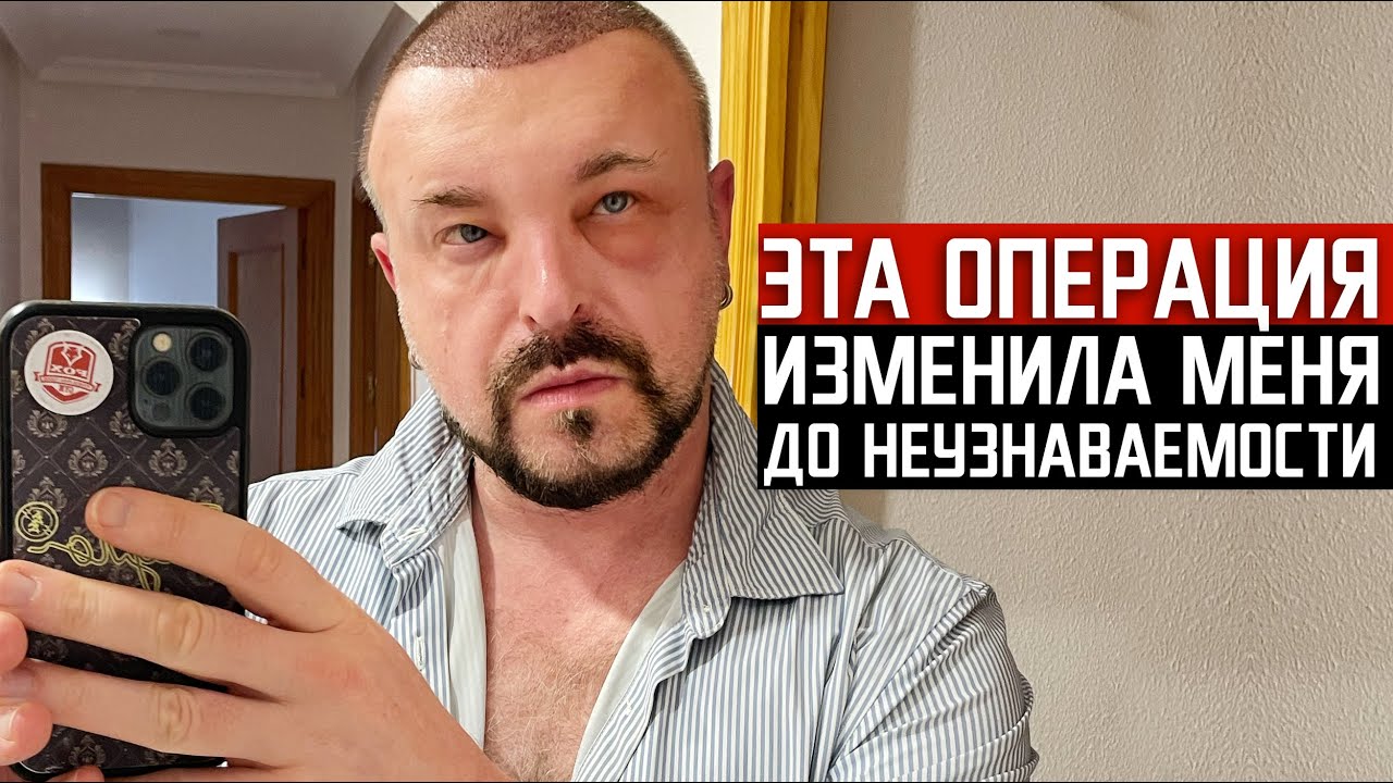 ЭТА ОПЕРАЦИЯ ИЗМЕНИЛА МЕНЯ ДО НЕУЗНАВАЕМОСТИ / сколько стоит пересадка волос / ТУРЦИЯ