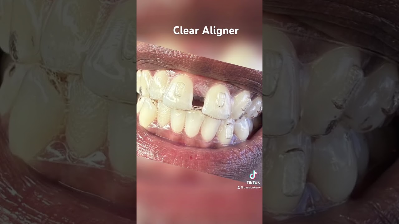 #2024 #invisalign #clearaligners #braces #invisalignsmile #suresmile #smile