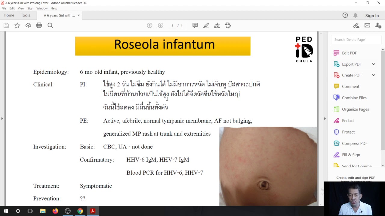 Mini lecture 30 Case demonstration Roseola infantum