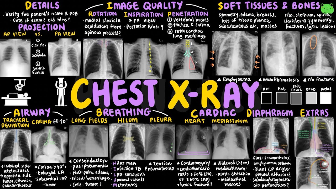 Chest X-Ray Interpretation | Clinical Skills 03 | Clinical Essentials | PPNotes