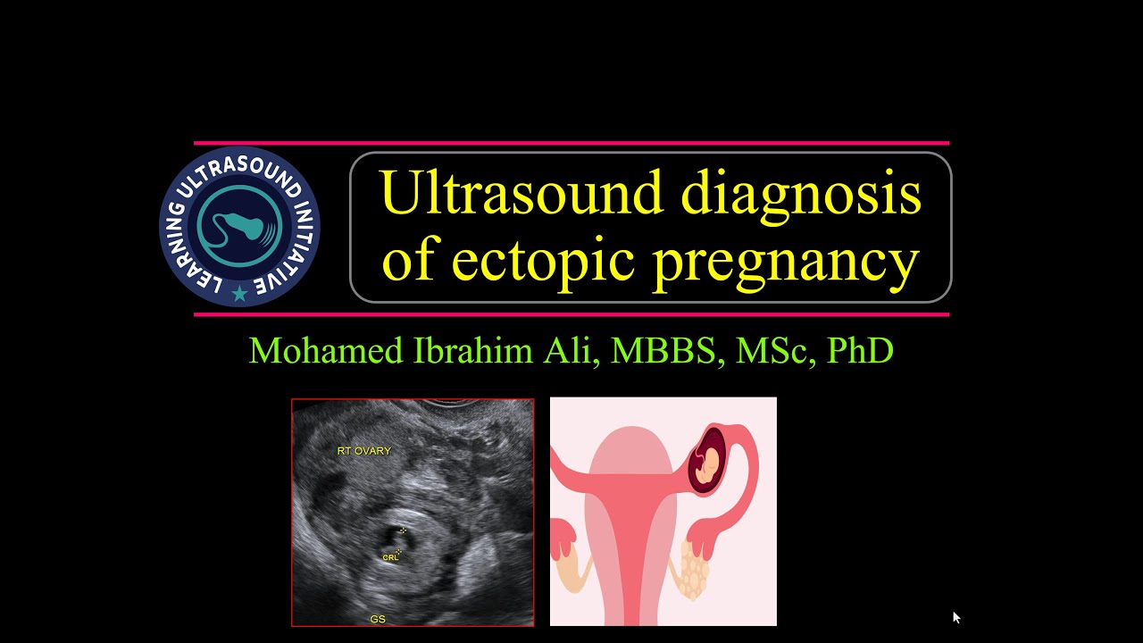 Ultrasound diagnosis of ectopic pregnancy