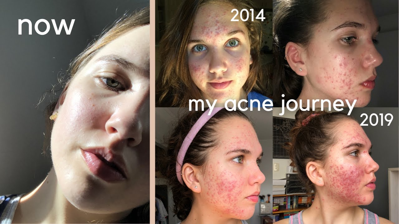 How I Cleared My Acne After 5 Years | My Struggle With Acne