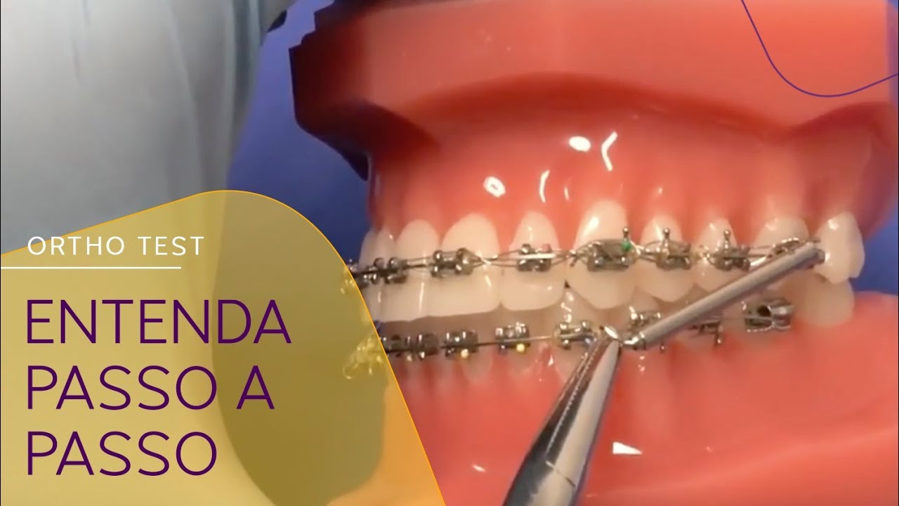 Instalação do Propulsor Mandibular GoToOne da Leone| APM