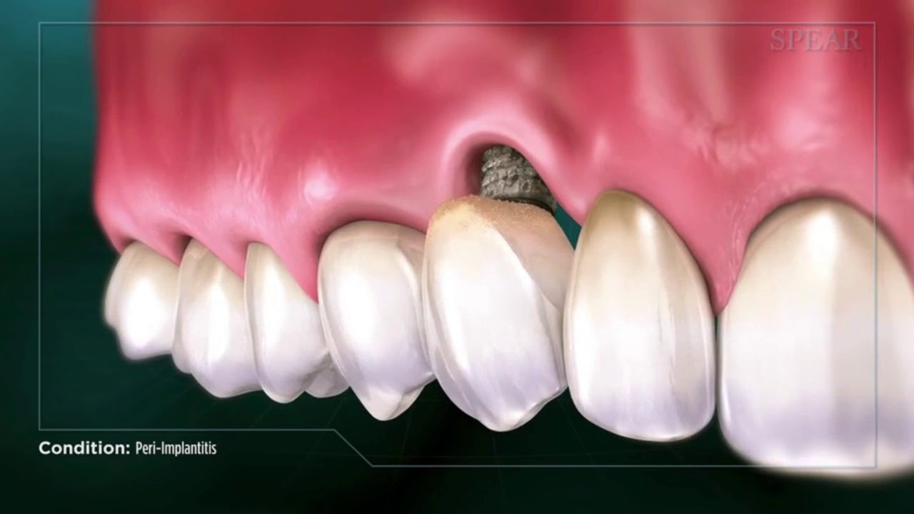 Peri-implantitis - Dental Implant Infection