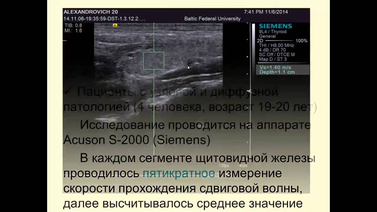 Тема  «Эластография сдвиговой волны щитовидной железы» 11 11 2014