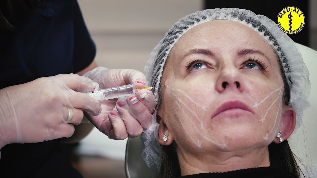 Zabieg implantacji nici liftingujących PDO w Med-All w Krakowie