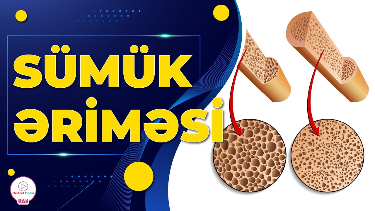 SÜMÜK ƏRİMƏSİ / OSTEOPOROZ / SÜMÜK ƏRİMƏSİNİN MÜALİCƏSİ