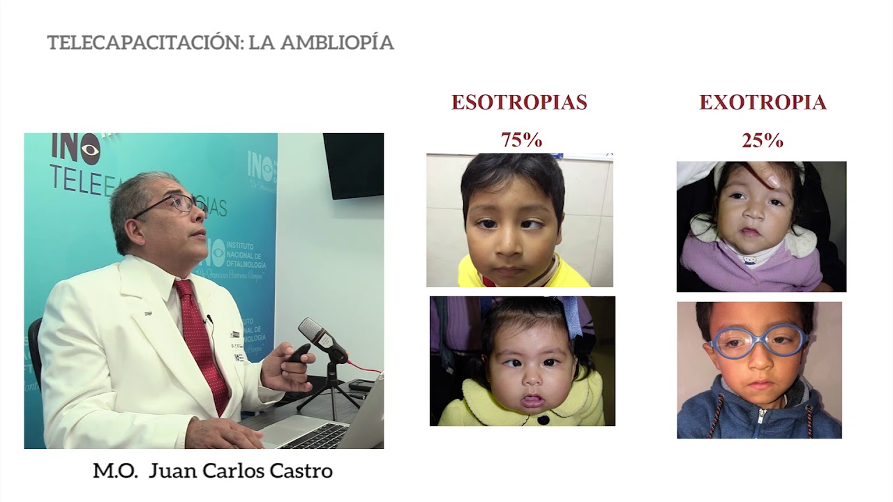 Telecapacitacion La Ambliopia Dr .Juan Carlos Cstro Rodriguez