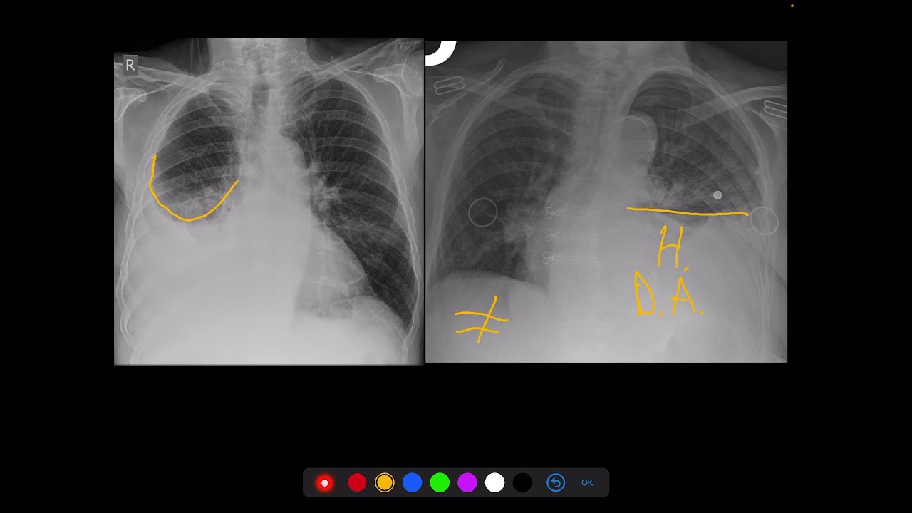 Radiografía de torax : Distinguir Hemothorax VS  derrame pleural