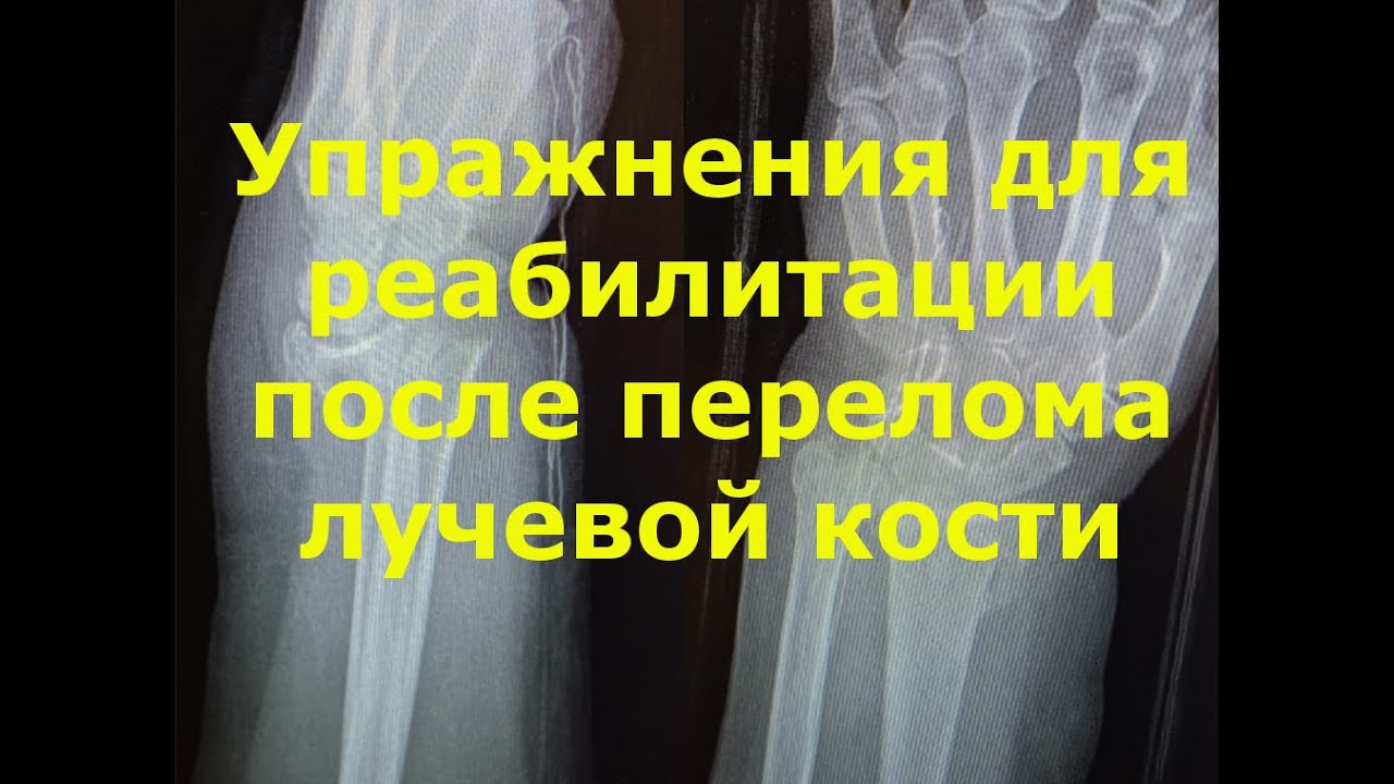 Упражнения для реабилитации после перелома лучевой кости. Вторая версия.
