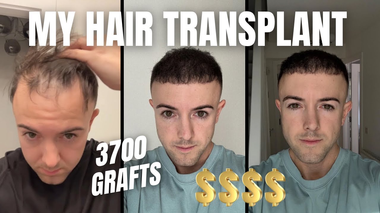 My Hair Transplant Experience + What They DON’T Tell You