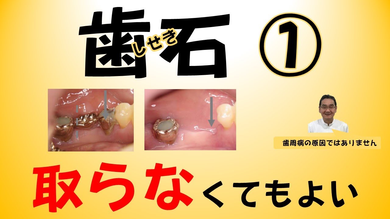 歯石は取らなくても良い