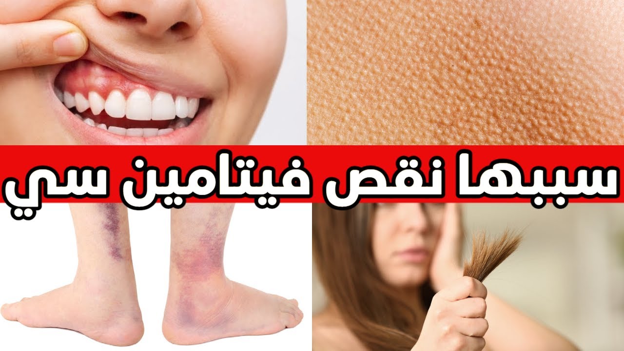 علامات تدل على نقص فيتامين سي لا يعلمها معظم الناس