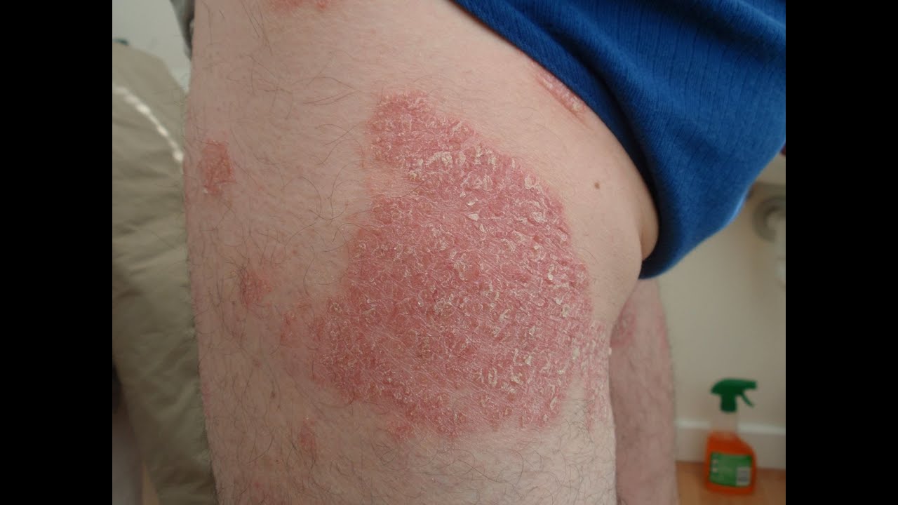 Chinese Medicine Dermatology talk 6 -- Psoriasis  by Dr. Hua Cao