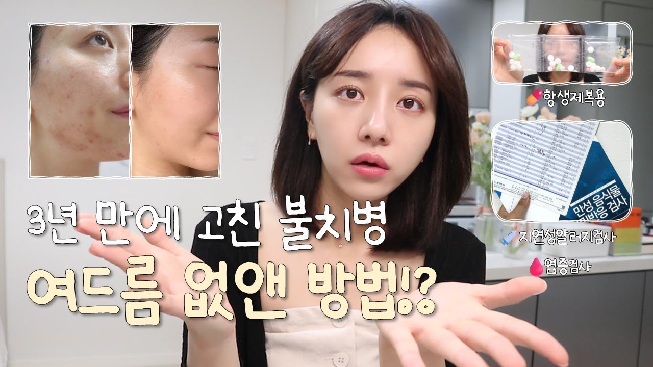 광고❌ 3년 만에 여드름 없앤 방법ㅣ지연성알러지, 염증 검사💉ㅣ항생제 복용💊ㅣ기초 루틴, 화장품 추천