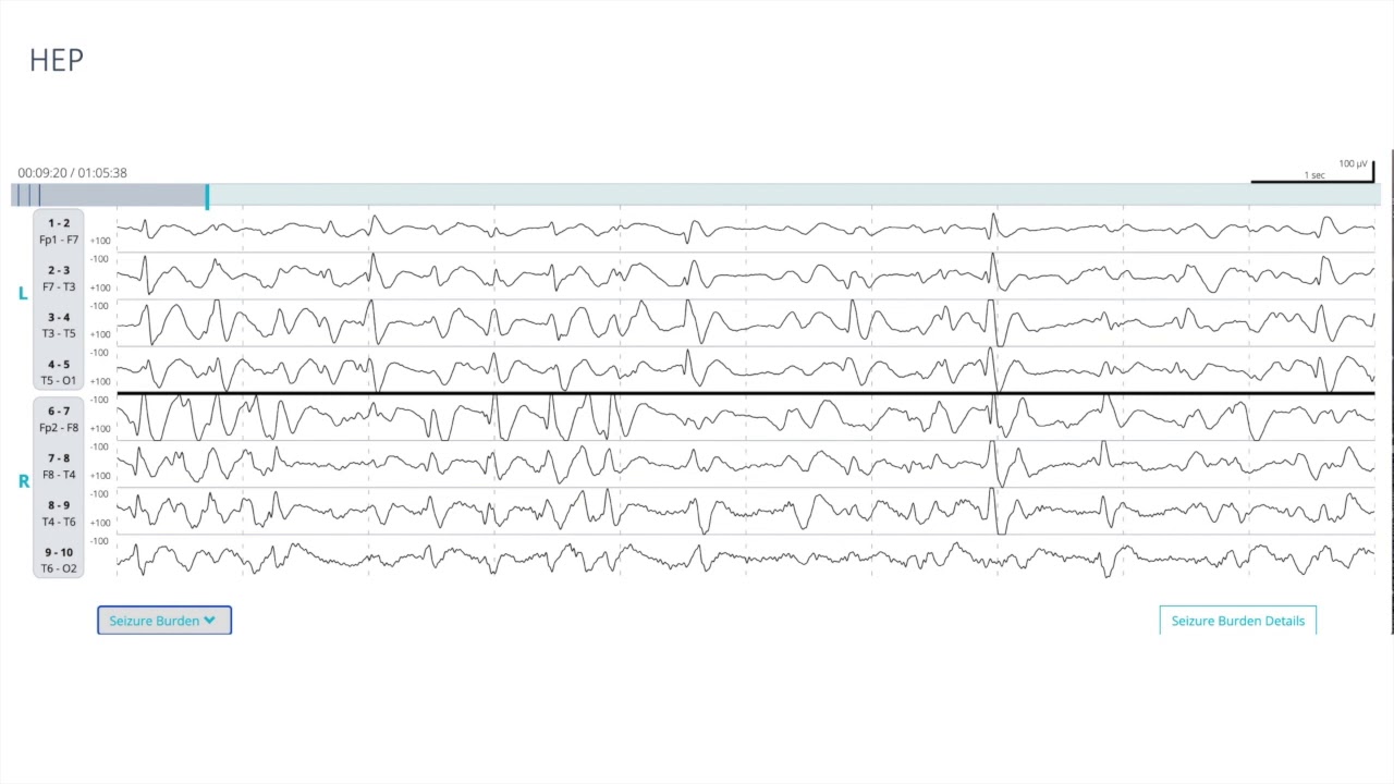 EEG Atlas B3: Understand EEG Through Examples With The Ceribell Rapid Response System