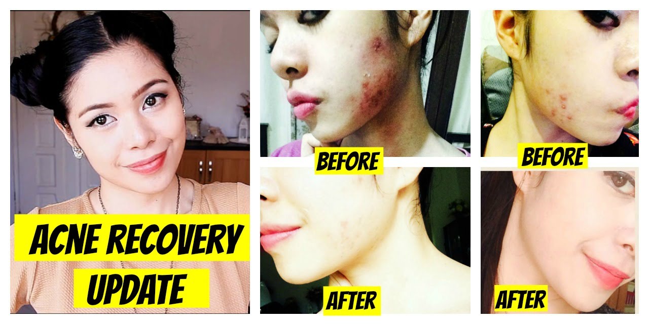 Acne Recovery Update-Hyperpigmentation, Rosacea, Diet and Scars?