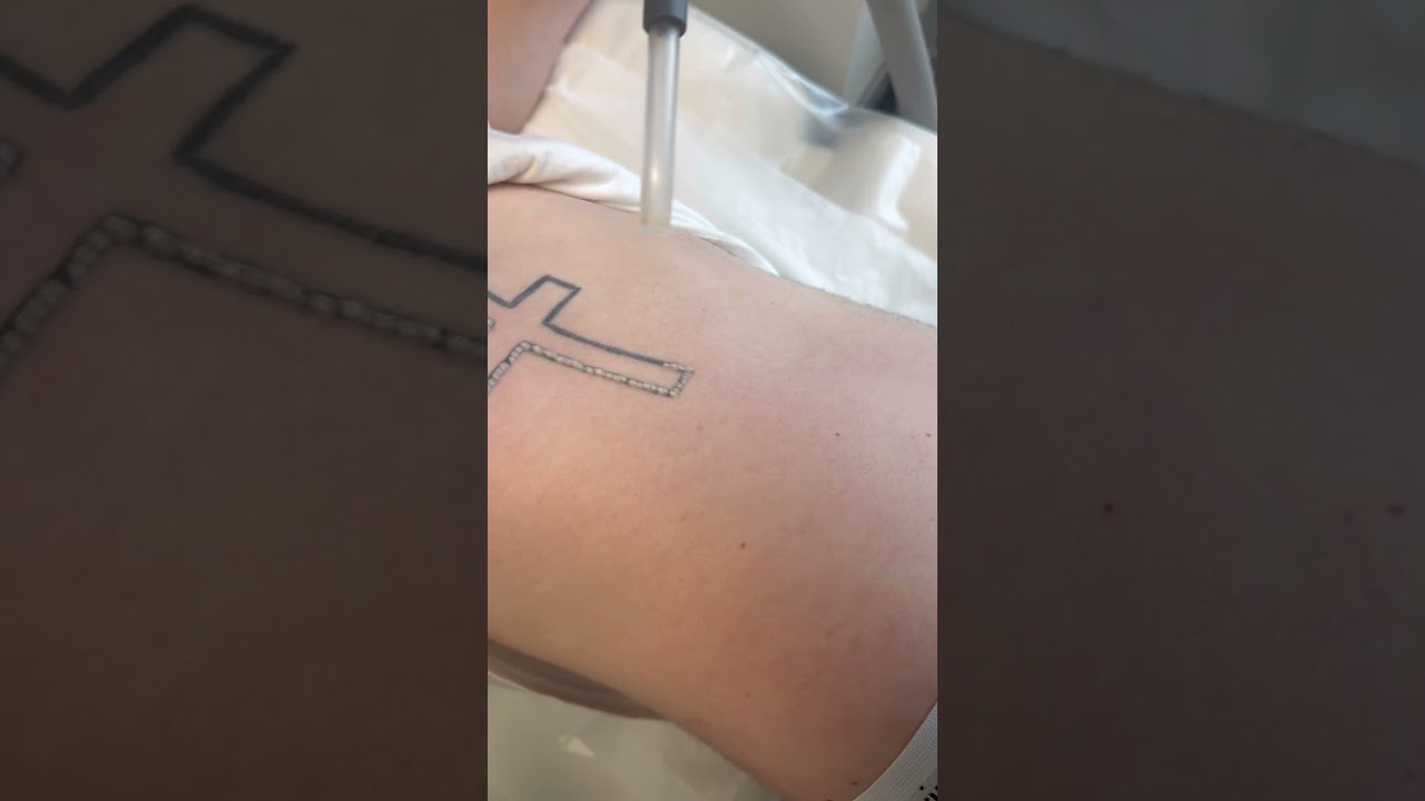 #laser