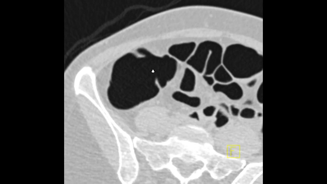 Submucosal polyp in ascending colon