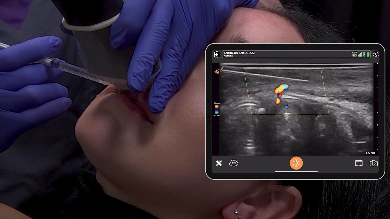 Ultrasound Guided Lip Filler Treatment