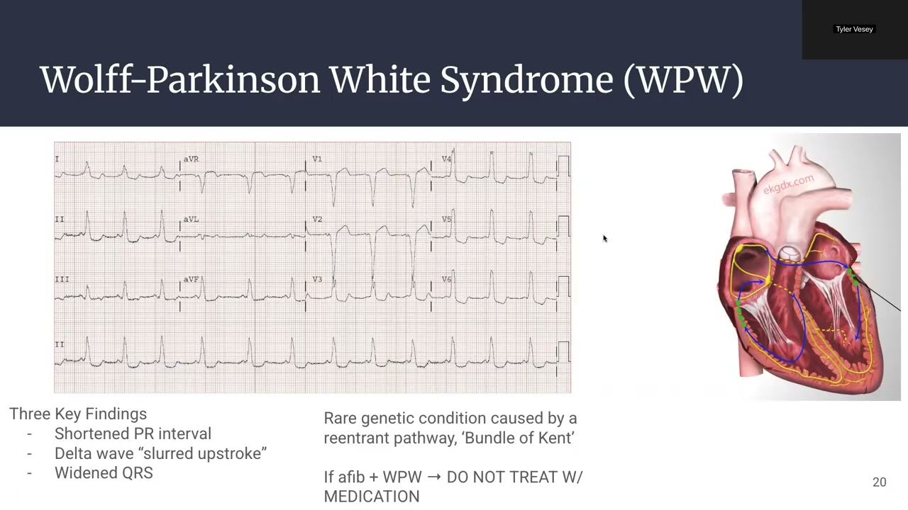 March - Management of Adult Tachycardia