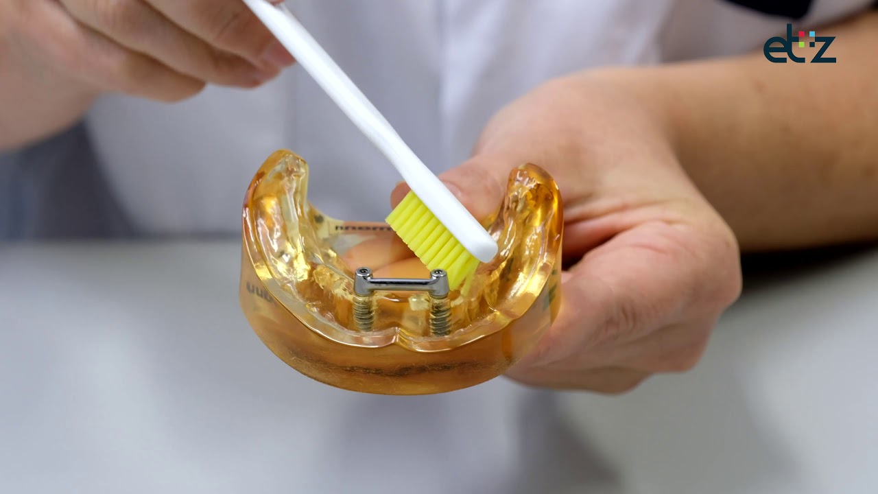 Poetsinstructie implantaten [Mond-, Kaak- en Aangezichtschirurgie]