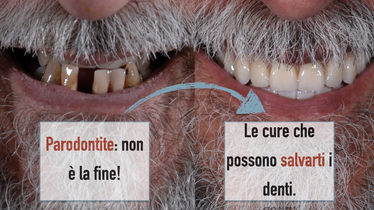 Parodontite: non è la fine! Le cure che possono salvarti i denti. PARTE 2.