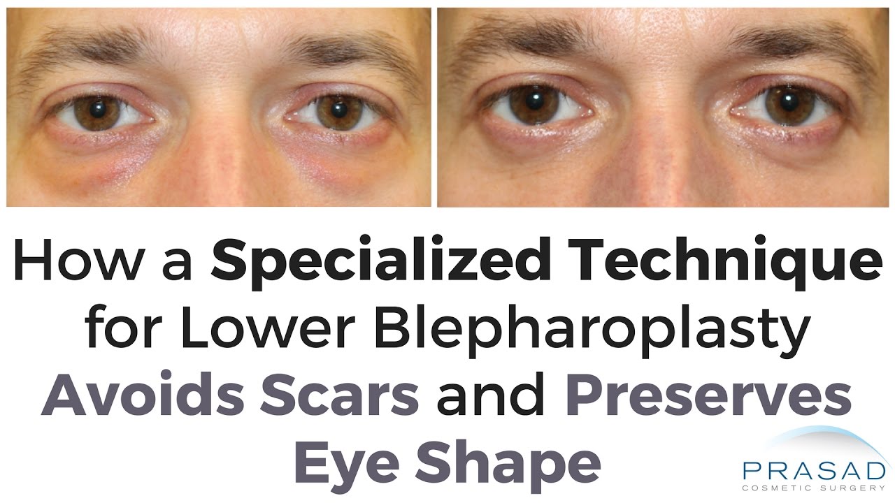 Why One Type of Eye Bag Surgery Avoids Complications and Scarring When Compared to the Other