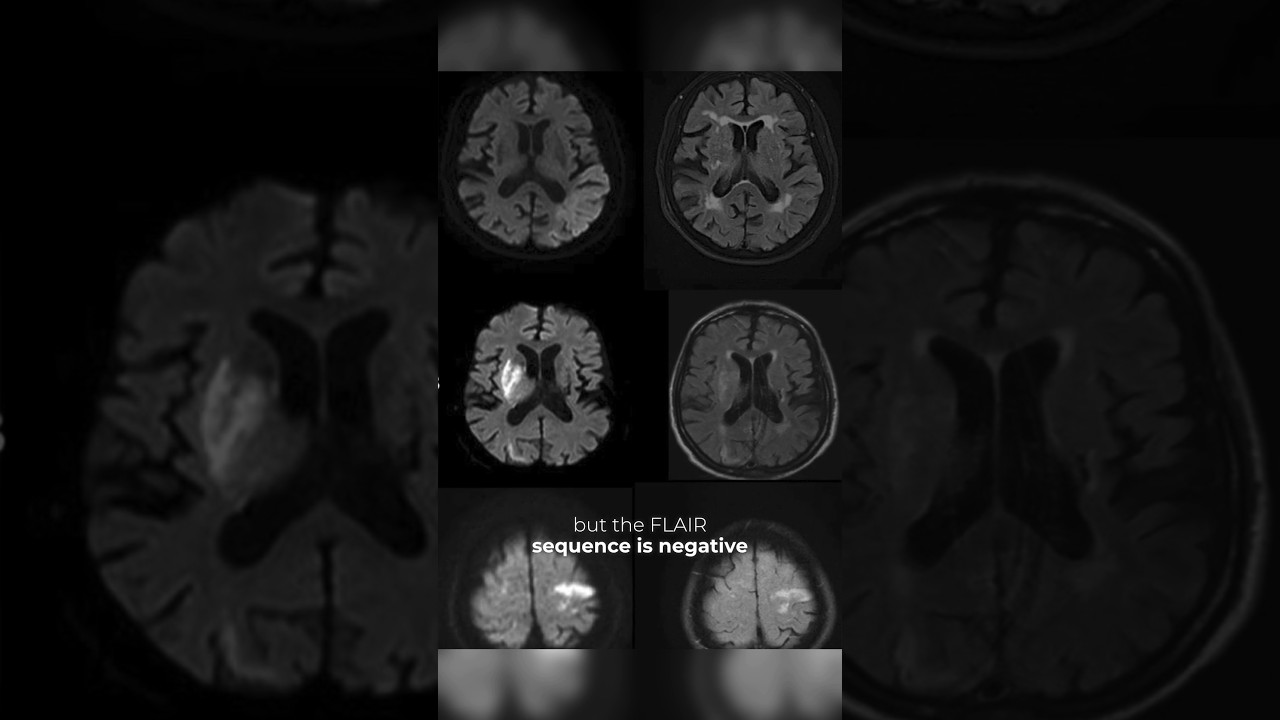 Wake Up Trail: Would you give thrombolytics beyond 4.5 hours in Ischemic #stroke?