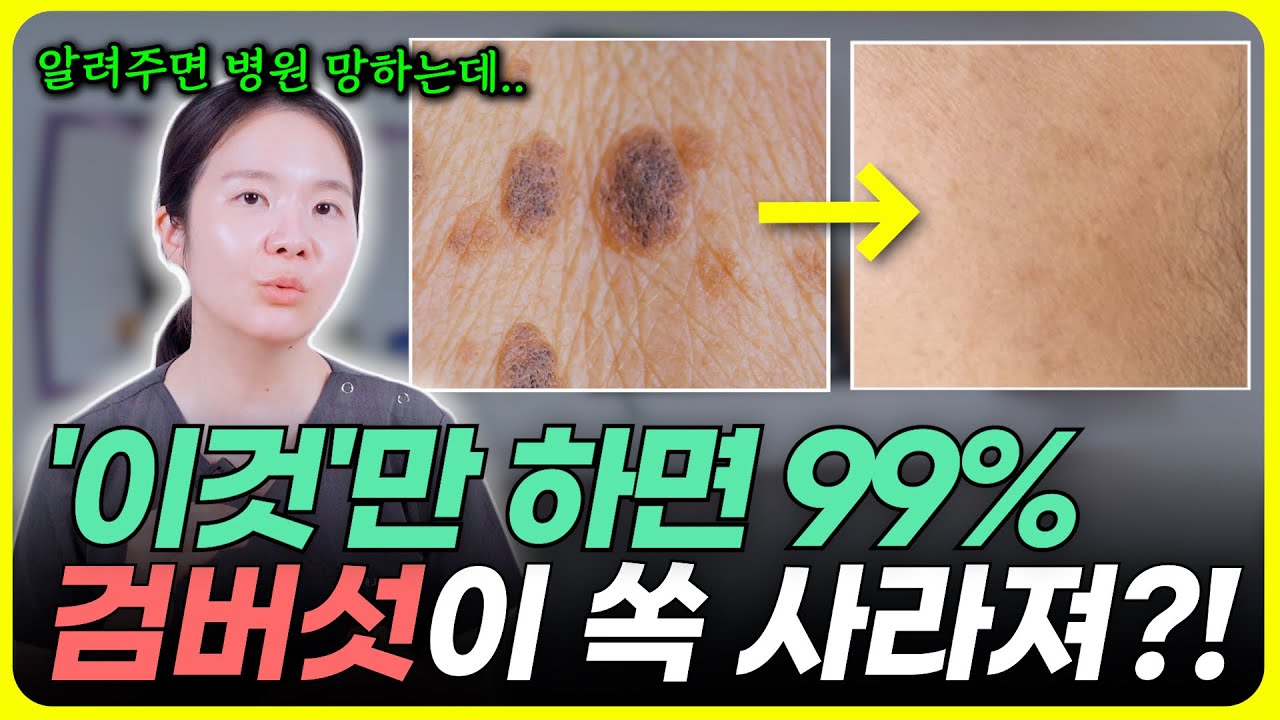 검버섯 없애는 방법‼️ ‘이것‘ 하시면 검버섯 1~2주만에 쏙 빠집니다 ( 식초, 레이저, 연고까지??!!)