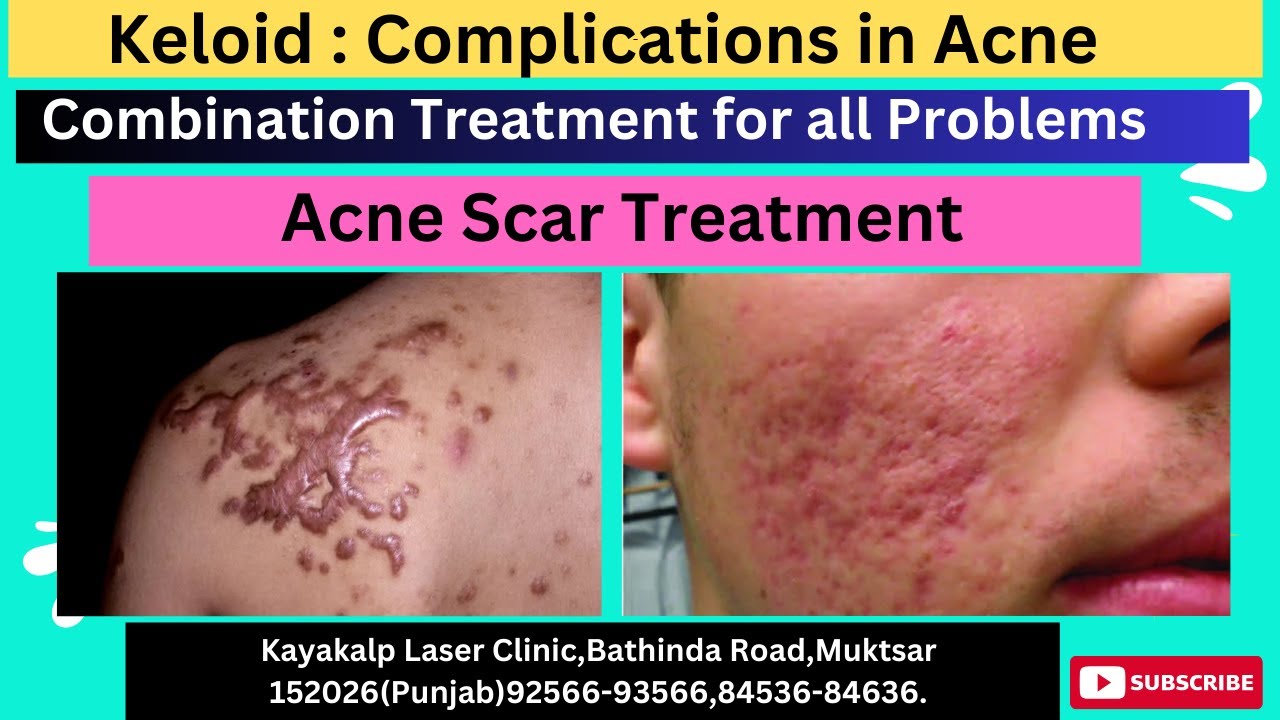 Keloid : Complications in Acne | Combination Treatment for all Problems | Acne Scar Treatment
