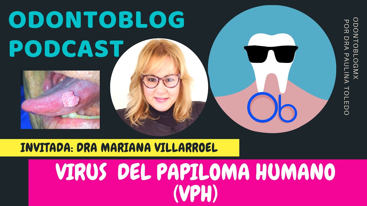 ODONTOBLOG PODCAST.- Virus del Papiloma Humano (VPH) con la Dra Mariana Villarroel 👩‍⚕️