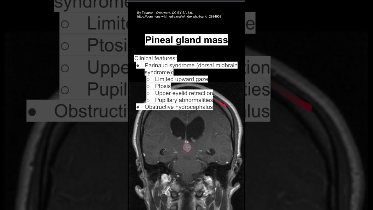 Pineal gland mass