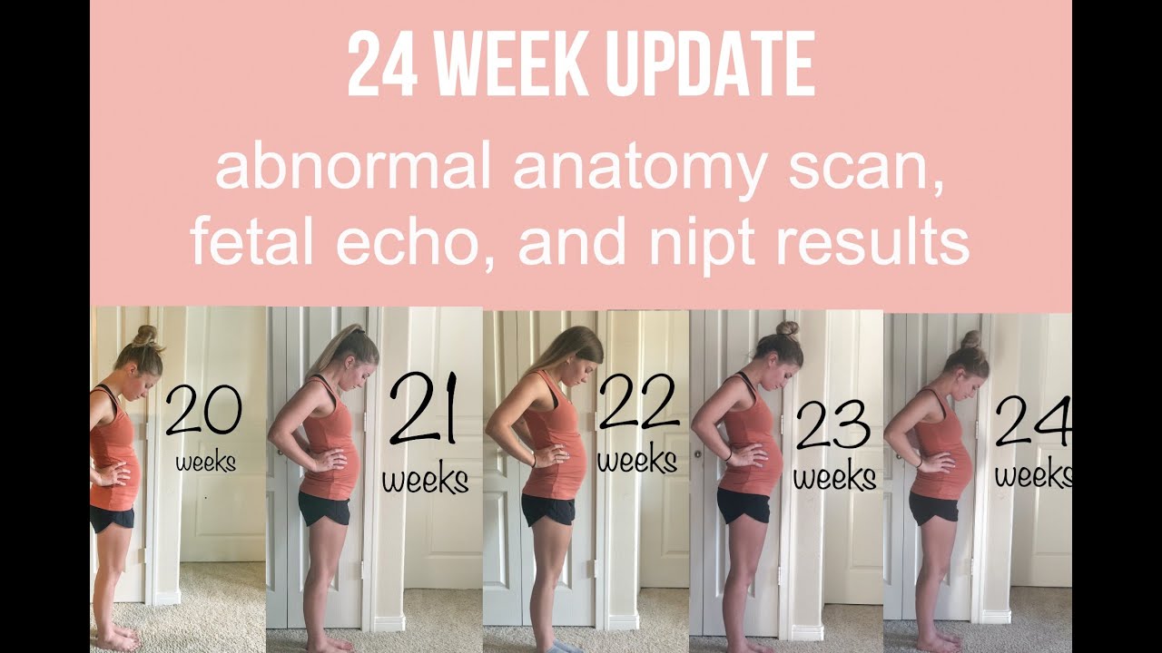 24 week update: two vessel cord, heart defects, positive NIPT screen for trisomy 18