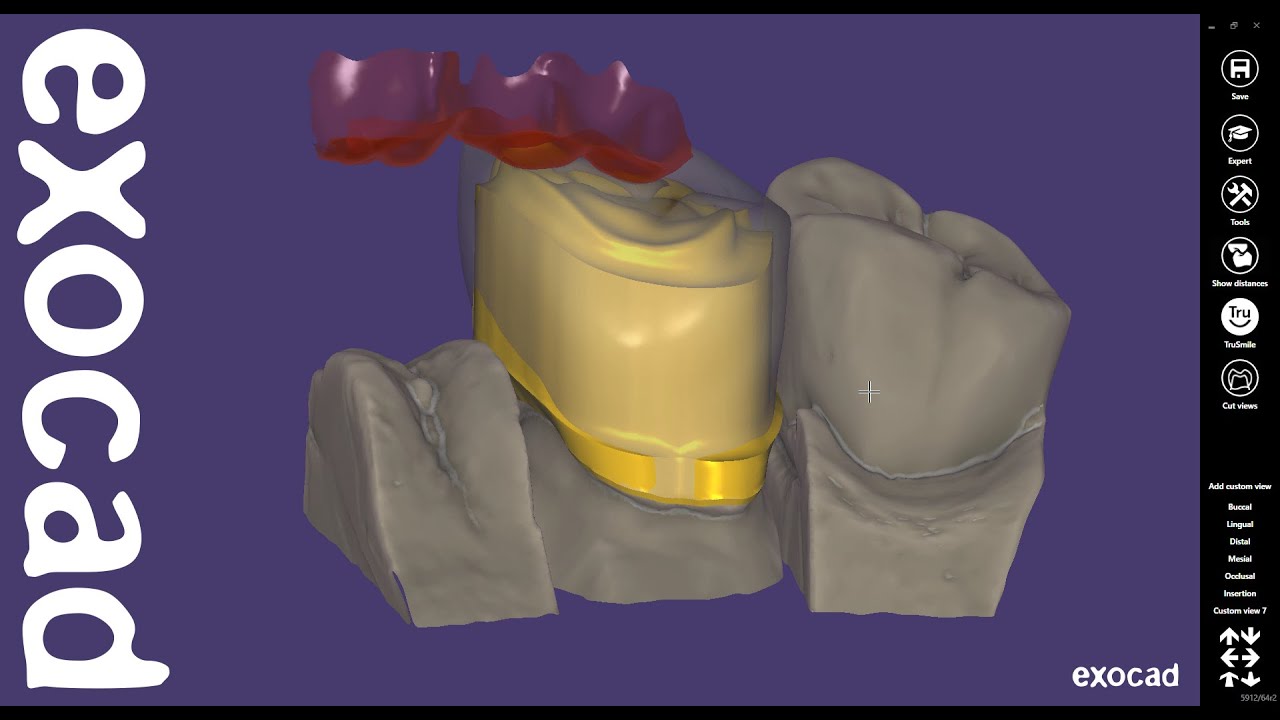 exocad Quick Guide: Advanced Telescopic Crown Design with Cutback