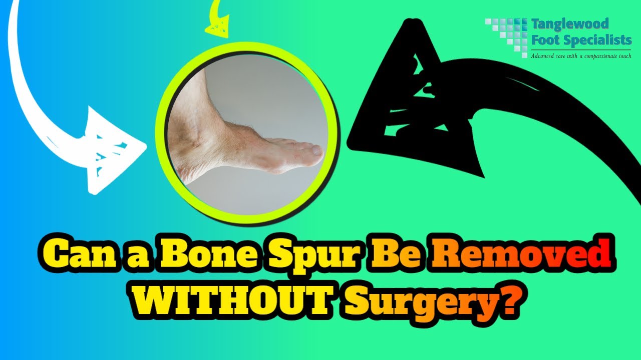 Can a Bone Spur on Feet Be Removed Without Surgery?