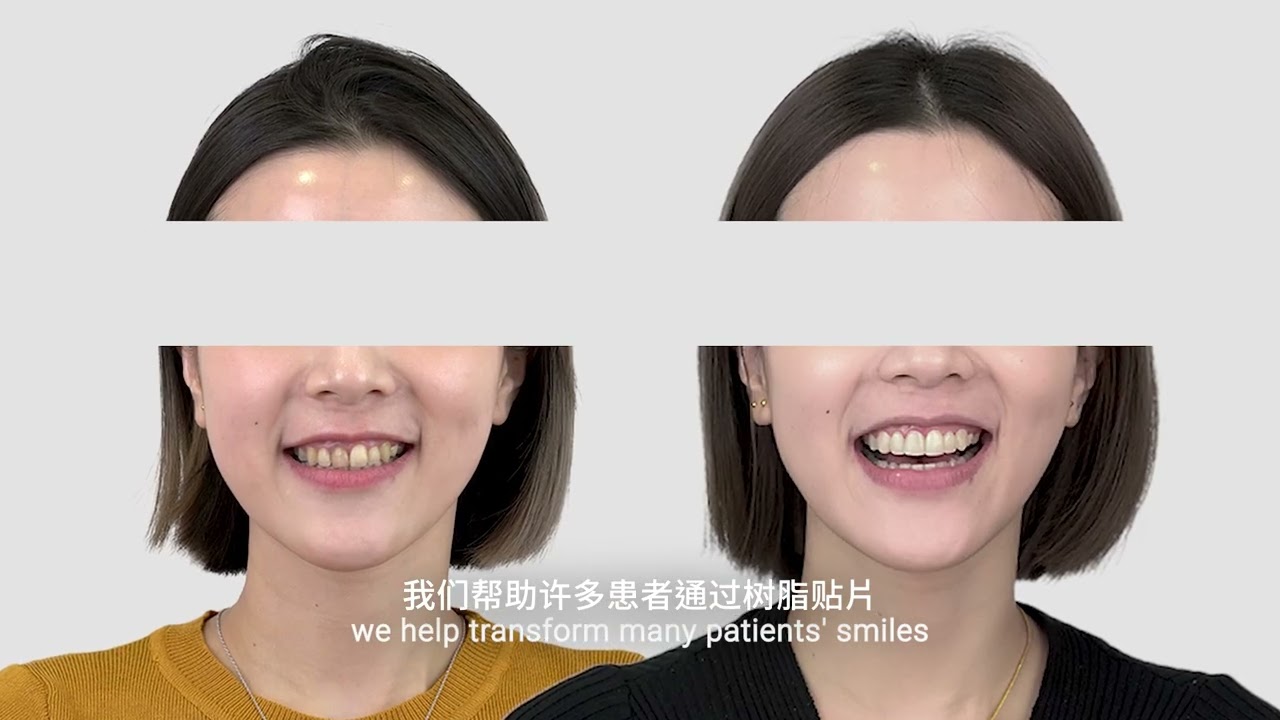 Composite Veneers - Dr Chelsea