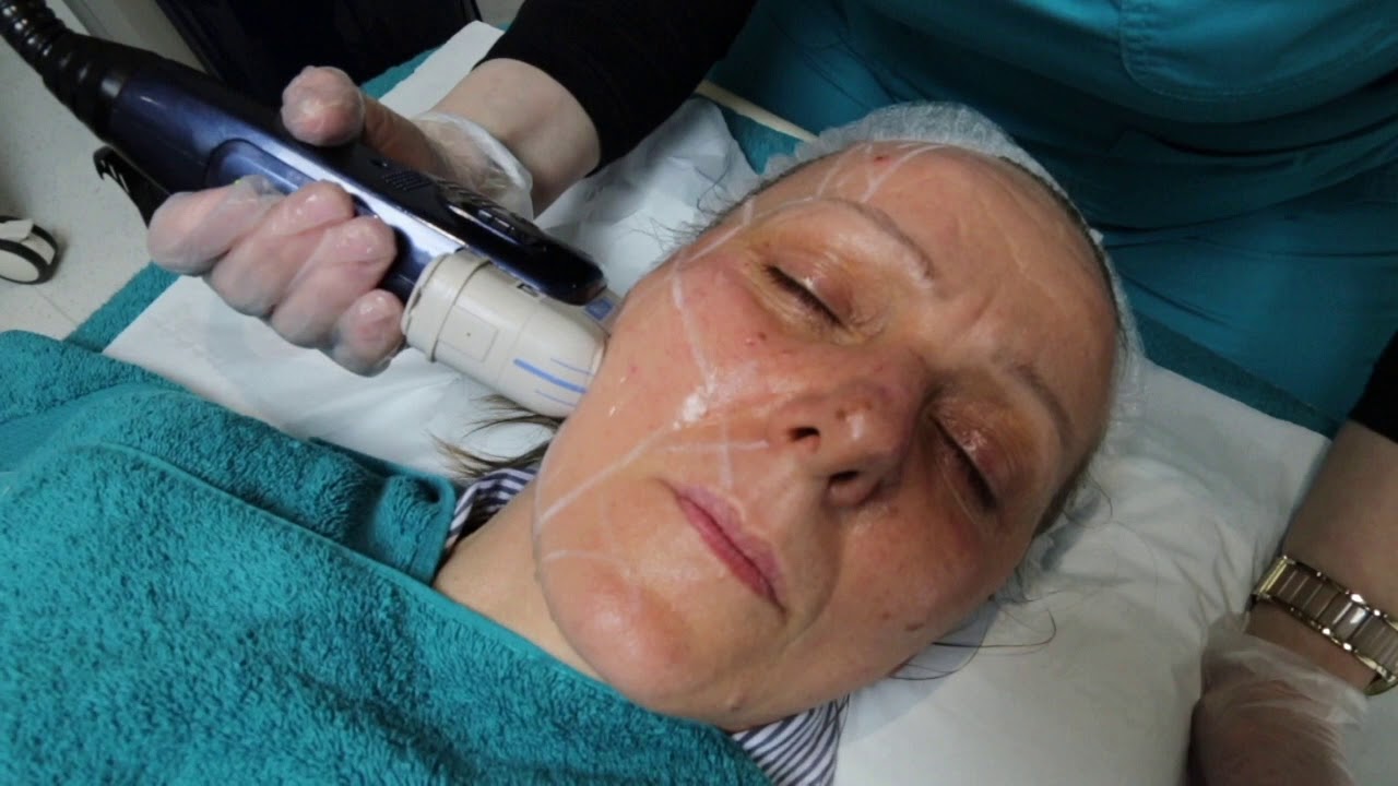 HIFU - Non-Surgical Skin Face Tightening