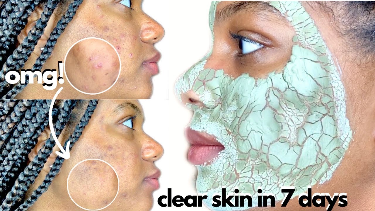 I Used The AZTEC INDIAN HEALING CLAY MASK Everyday to Clear Acne in One Week - Milan Alicia