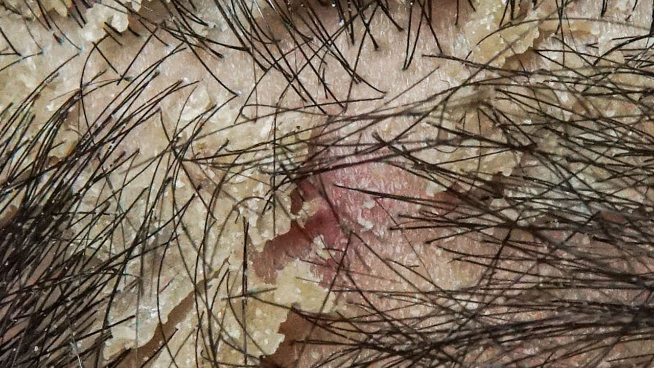 ASMR Satisfying Dandruff Treatment & Scalp Check  #DKMO3767
