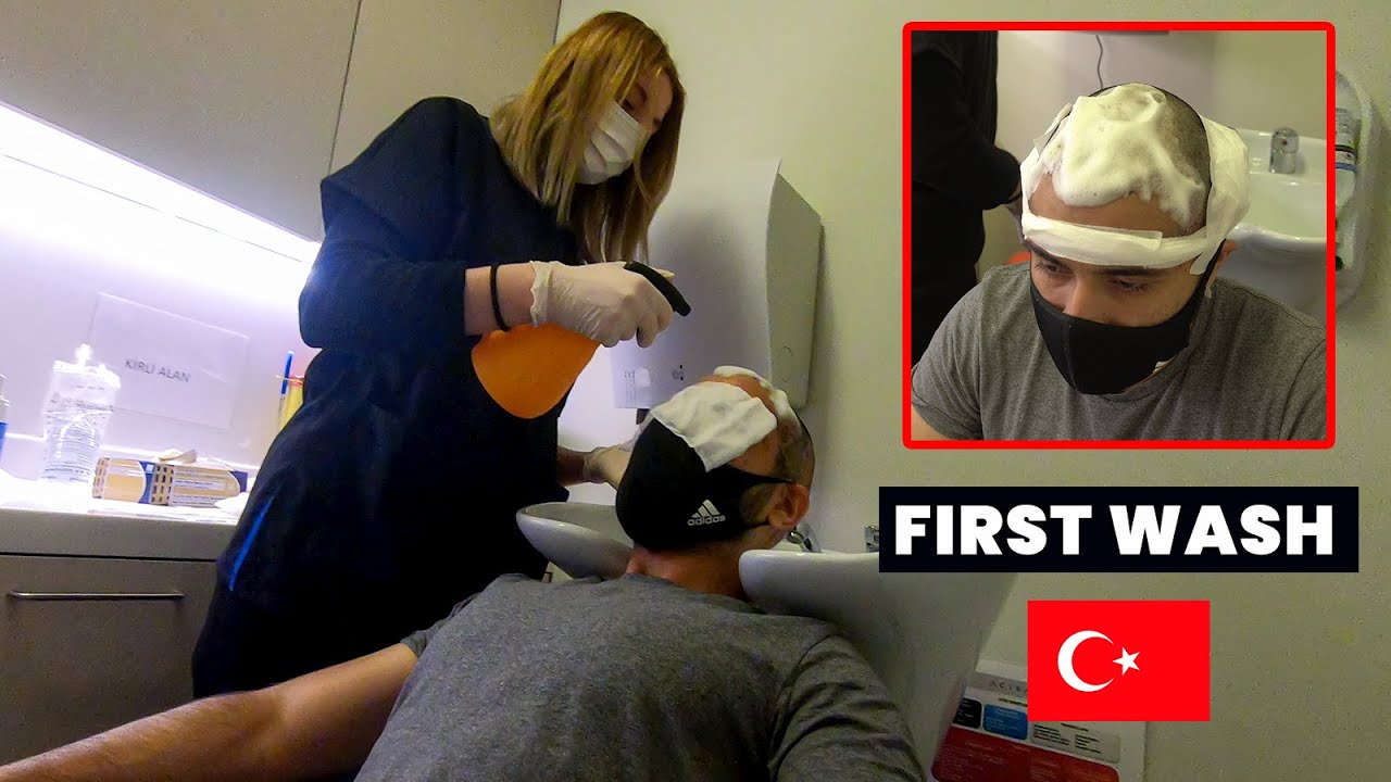 My First Head Wash After Hair Transplant in Turkey.