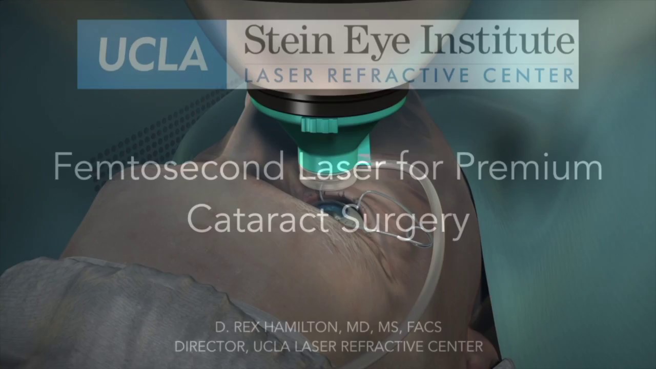 Understanding Femto-Assisted Cataract Surgery at UCLA