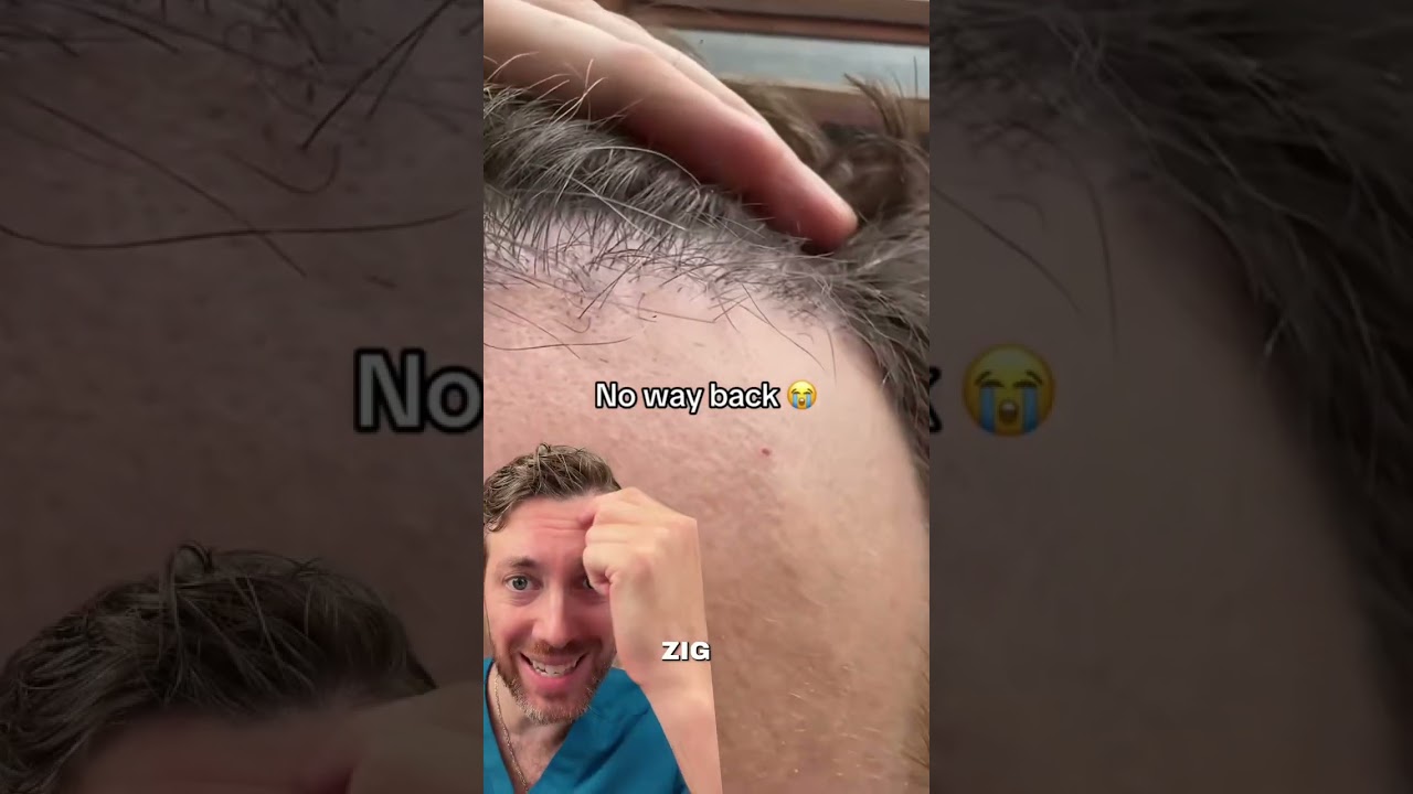 Why a Natural Irregularity Matters in Your Hairline