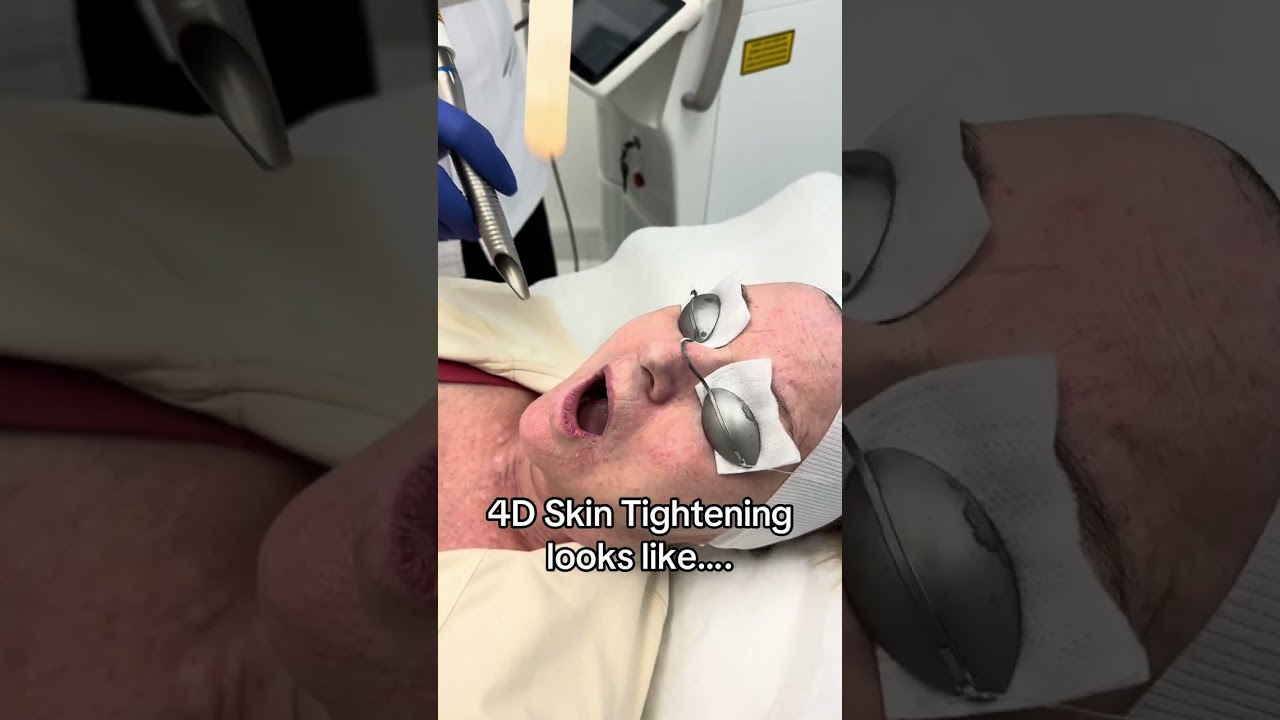 4D Skin Rejuvenation with Fotona Laser ✨