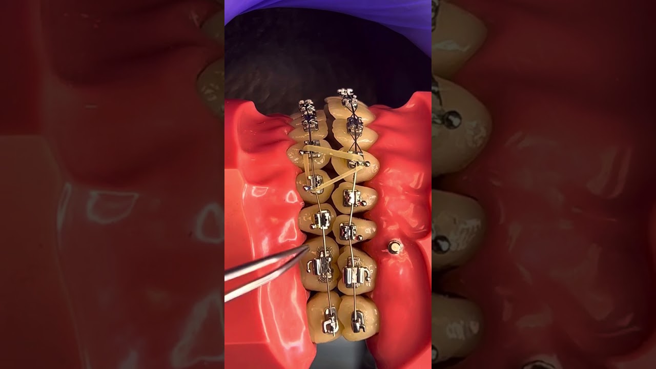 23/02/2025 - Dica 54  Fechamento da mordida aberta anterior com elásticos intermaxilares.