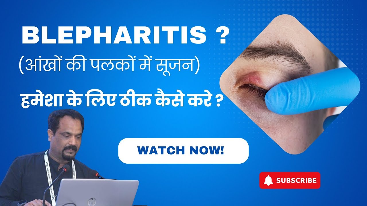 Blepharitis in Hindi | Causes, Symptoms and Treatment | The Health Guru